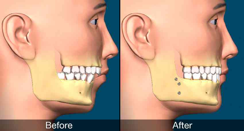 Jaw Alignment in Cosmetic Dentistry